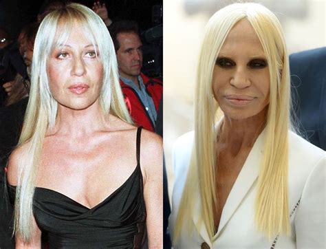 Donatella Versace Before Plastic Surger.